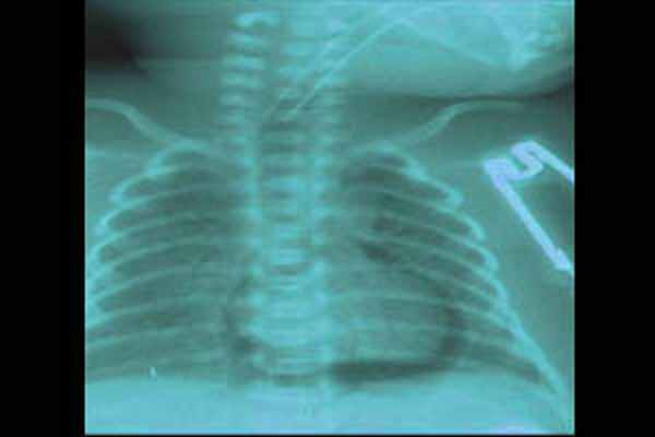 Пневмоперикард