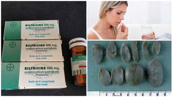 Лечение легочного сосальщика