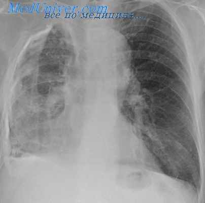 торакопластика