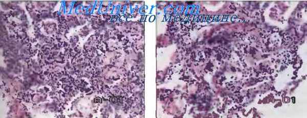 Грибковая пневмония