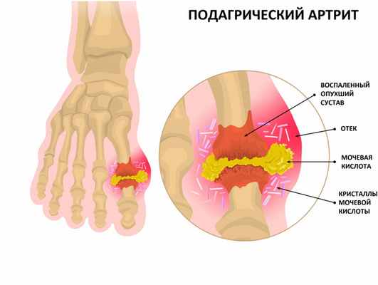 Подагрический артрит.jpg