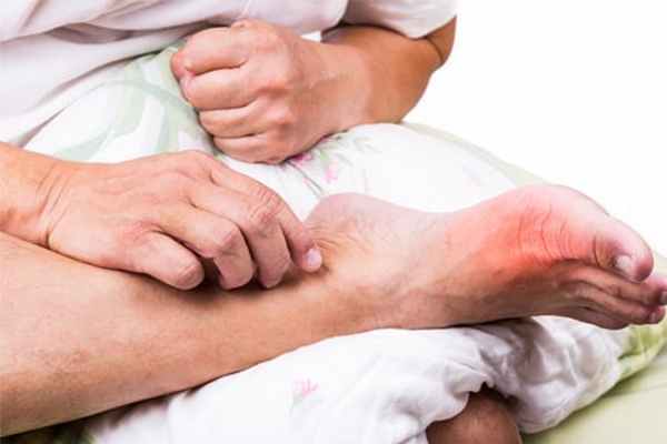 Подагрический артрит