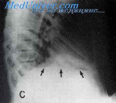 поддиафрагмальный абсцесс