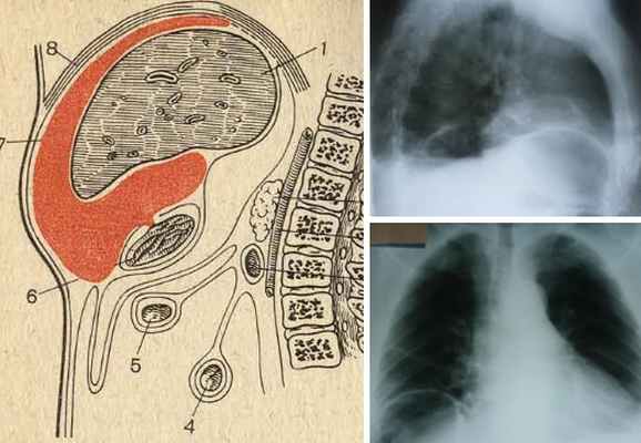 поддиафрагмальный абсцесс
