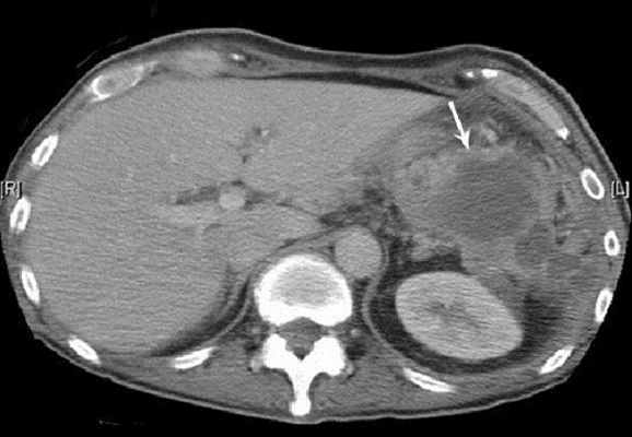 поддиафрагмальный абсцесс на мрт
