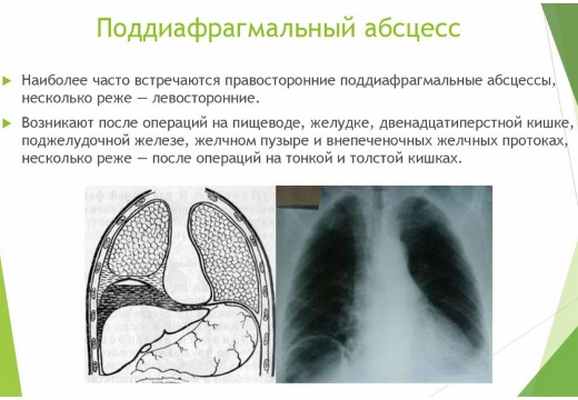 поддиафрагмальный абсцесс проявление