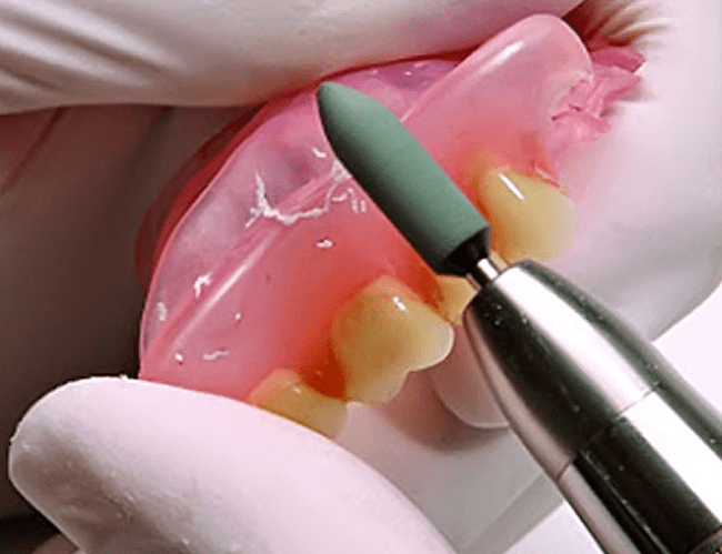 Коррекция съемного протеза