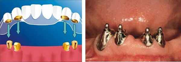 Протез на телескопических коронках