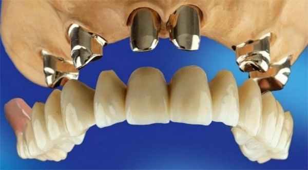Телескопические протезы зубные