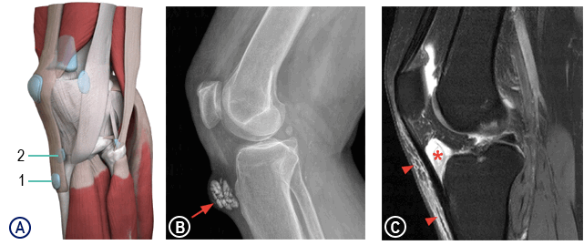 Инфрапателлярный бурсит
