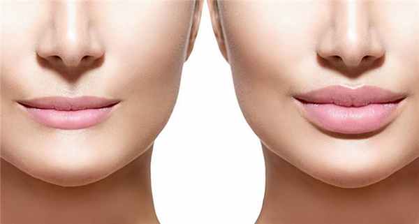 Как делают увеличение губ?