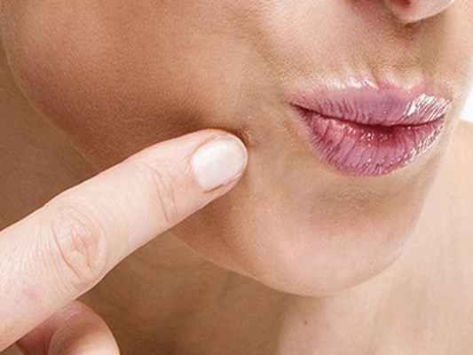 Что такое плоские бородавки