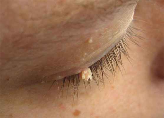 Папилломы на веке