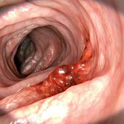 Рак толстой кишки