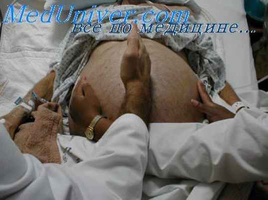 подвижность слепой кишки