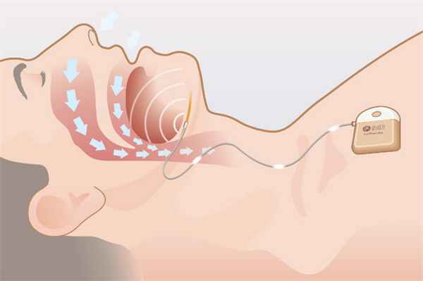 Стимуляция подъязычного нерва