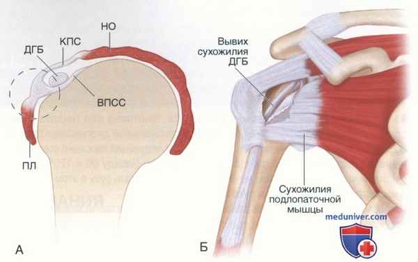 Операция артроскопический бицепс-тенодез