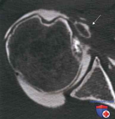 Операция артроскопический бицепс-тенодез