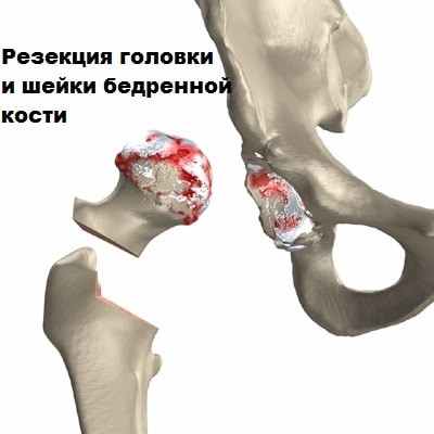 Эндопротезирование тазобедренного сустава