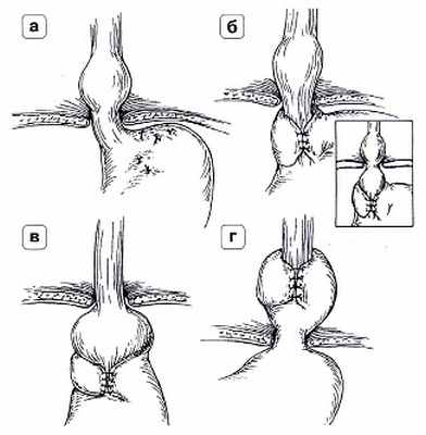 Рис. 4. Осложнения после фундопликации по Ниссену: а) полный разворот манжетки при прорезывании швов; б) соскальзывание; в) сформированная вокруг кардиального отдела желудка манжетка; г) втягивание антирефлюксной манжетки в заднее средостение при укорочении пищевода