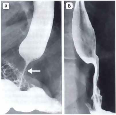 Рис. 2. Рентгенограмма. Осложнения после фундопликации по Ниссену: а) дисфагия, обусловленная излишне туго сформированной манжеткой; б) дисфагия, вызванная излишней длинной фундопликационной манжеткой. В обоих случаях видны признаки нарушения проходимости в области пищеводно-желудочного перехода и супрастенотическое расширение пищевода выше наложенной манжетки