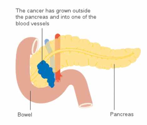 Операция Уиппла на поджелудочной железе