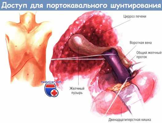 Доступ для портокавального шунтирования