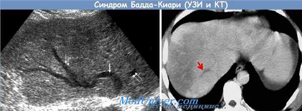 синдром Бадда-Киари