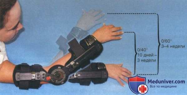 Операция шва и реконструкции сухожилия трехглавой мышцы