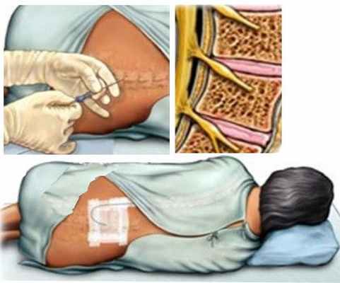 Эпидуральная анестезия - безболезненный и безопасный метод обезболивания при операциях