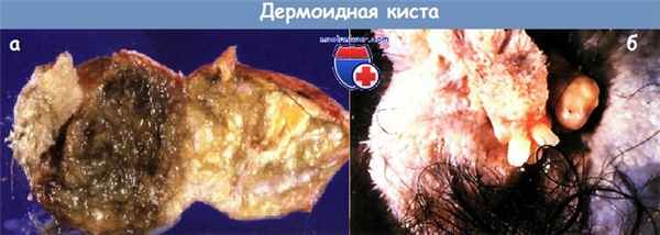 Дермоидная киста - зрелая кистозная тератома