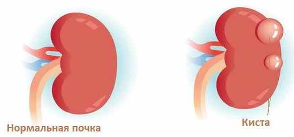 поликистоз почки