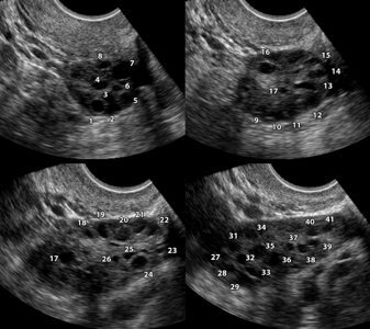 polikistoz_yaichnikov_3