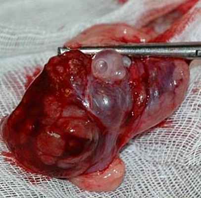 Синдром поликистозных яичников