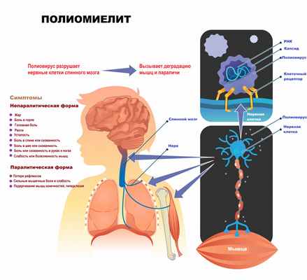 Полиомиелит.jpg