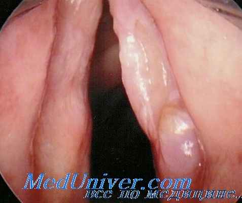 полипы гортани