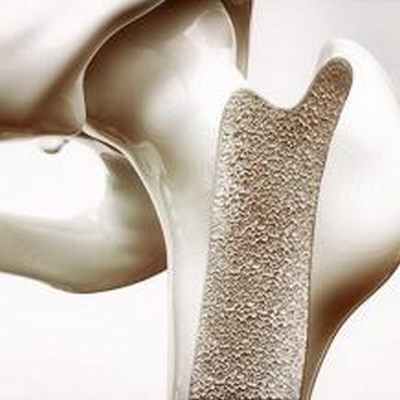 Остеопороза суставов: как лечить, симптомы, виды