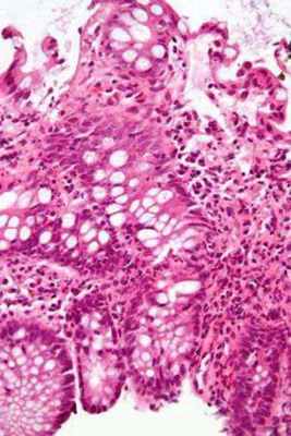 рак поперечно ободочной кишки