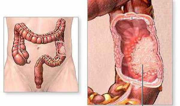 брыжейка поперечной ободочной кишки