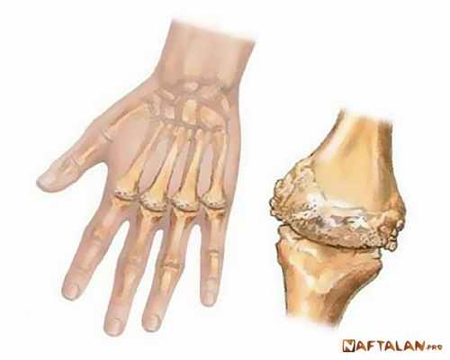 Лечение инфекционного неспецифического артрита в санаториях Нафталана