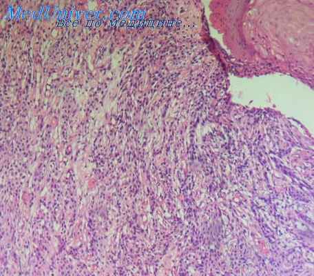 эккринная порокарцинома