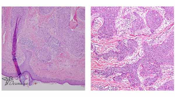 Эккринная порокарцинома