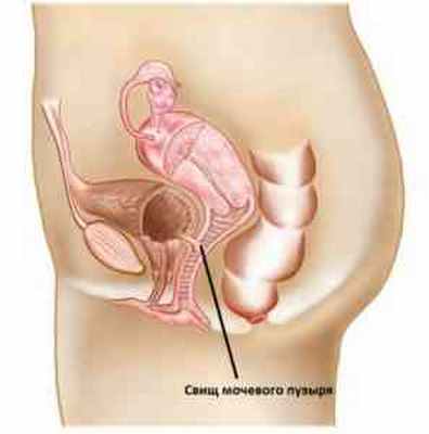 свищ мочевого пузыря
