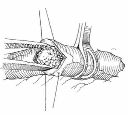 Описание: Вследствие неровной поверхности камень обычно плотно фиксирован к слизистой оболочке