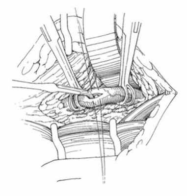 Описание: Мочеточник выше камня берут зажимом Бэбкока или на резиновую держалку