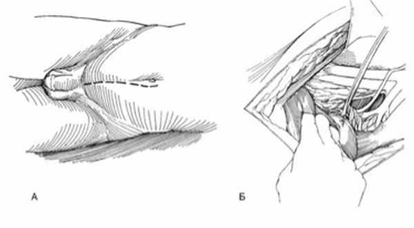 Описание: точником дистальнее этой аркады, но проксимальнее следующей, и на этом уровне снова берут мочеточник на резиновую держалку. Продолжают мобилизацию таким образом до тех пор, пока мочеточник не будет выделен на участке, достаточном для уретеролитотомии (либо для реконструкции или уретеронеоцистостомии). Чтобы достичь средней трети мочеточника, пересекают ножницами Лахея серповидную часть поперечной фасции, фиксирующую брюшину к боковой стенке живота. У женщин этот отдел мочеточника проходит под сосудами, кровоснабжающими матку, поэтому при его выделении требуется особая осторожность. Иногда, например при повторных вмешательствах на тазовых органах, вскрытие брюшной полости облегчает доступ и позволяет обнажить мочеточник чрезбрюшинно.