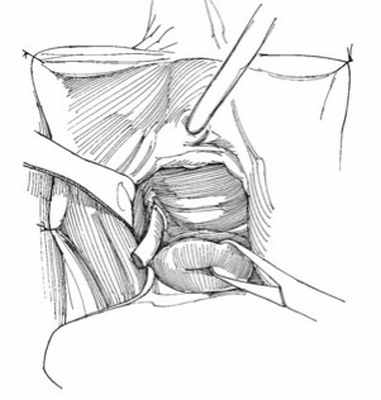 Описание: При кровоточивости тканей и сомнениях в гемостазе устанавливают дренажную трубку