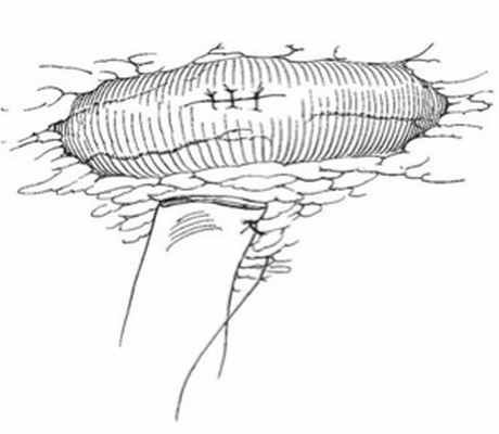 Описание: Отверстие в стенке мочеточника закрывают