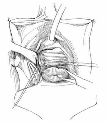 Описание: Вводят заднее влагалищное зеркало, половые губы подшивают к коже