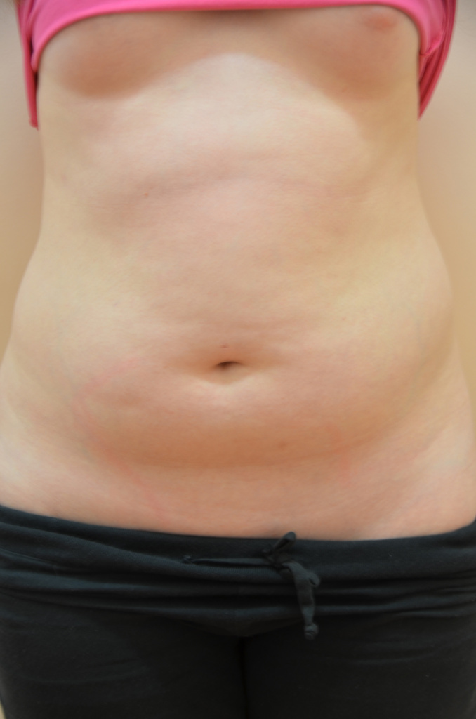 Рана после лапароскопии через 2 месяца после операции